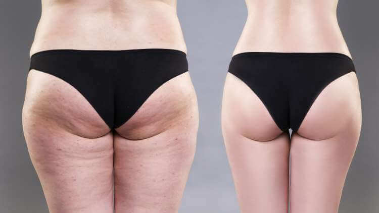 Gastric Bypass Surgery