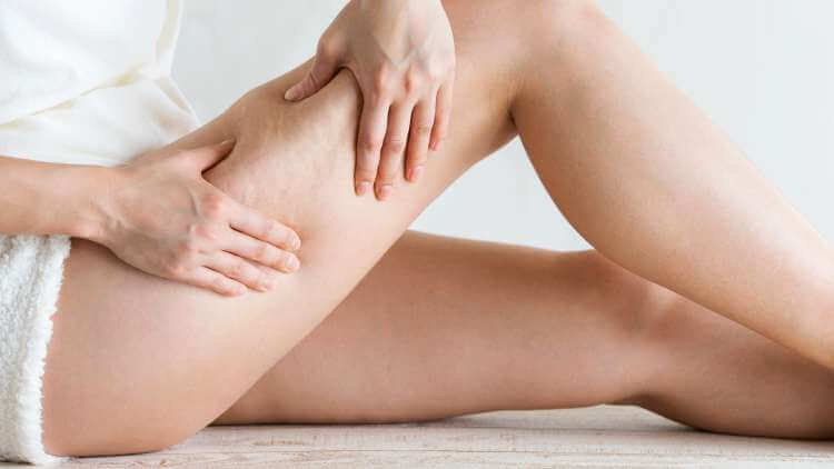 Can You Ever Really Get Rid of Cellulite?