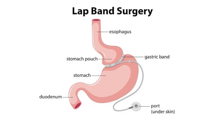 Lap Band Surgery Cost